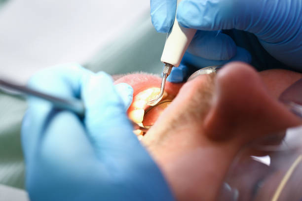 Best Knocked-Out Tooth (Avulsed Tooth) Treatment in Dellwood, MN